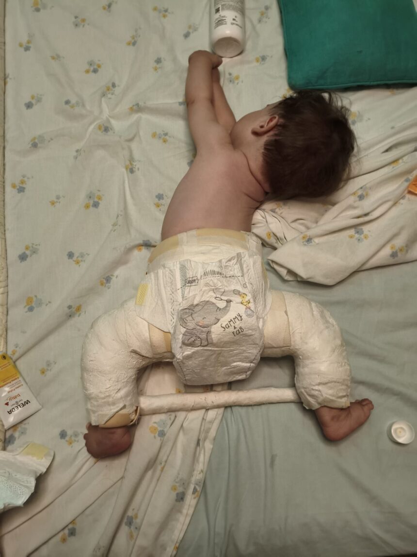 Una madre lucha en Málaga por el cribado de cadera tras el caso de su bebé, enyesado hasta el ombligo