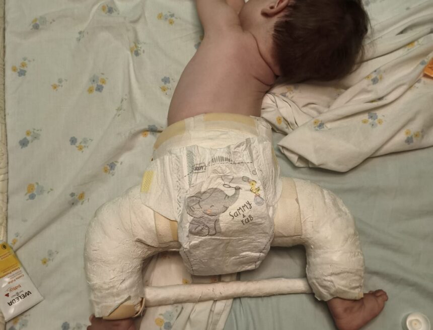 Una madre lucha en Málaga por el cribado de cadera tras el caso de su bebé, enyesado hasta el ombligo